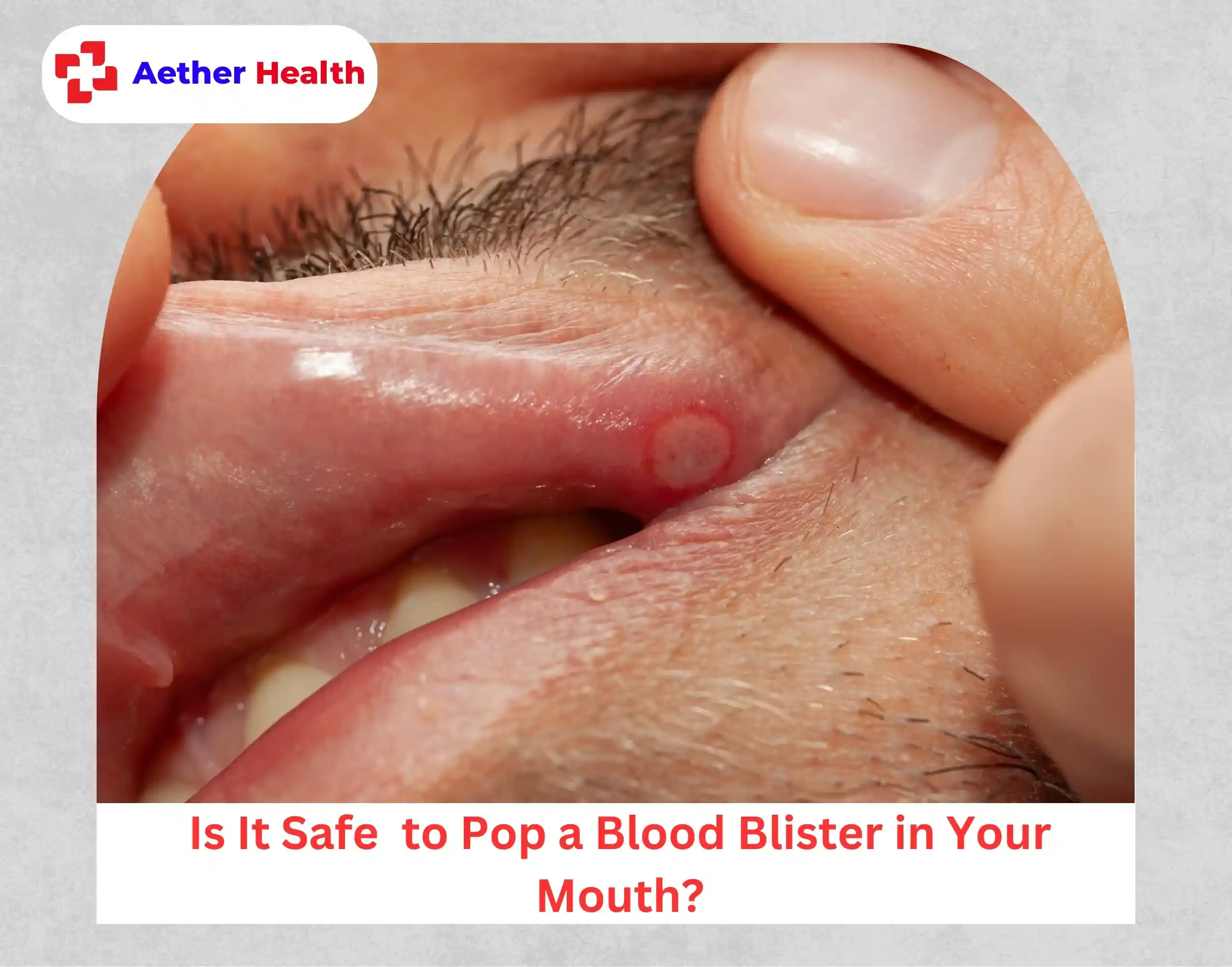 Is It Safe to Pop a Blood Blister in Your Mouth